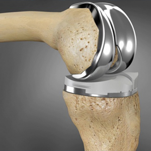 knee replacment waleus clinic